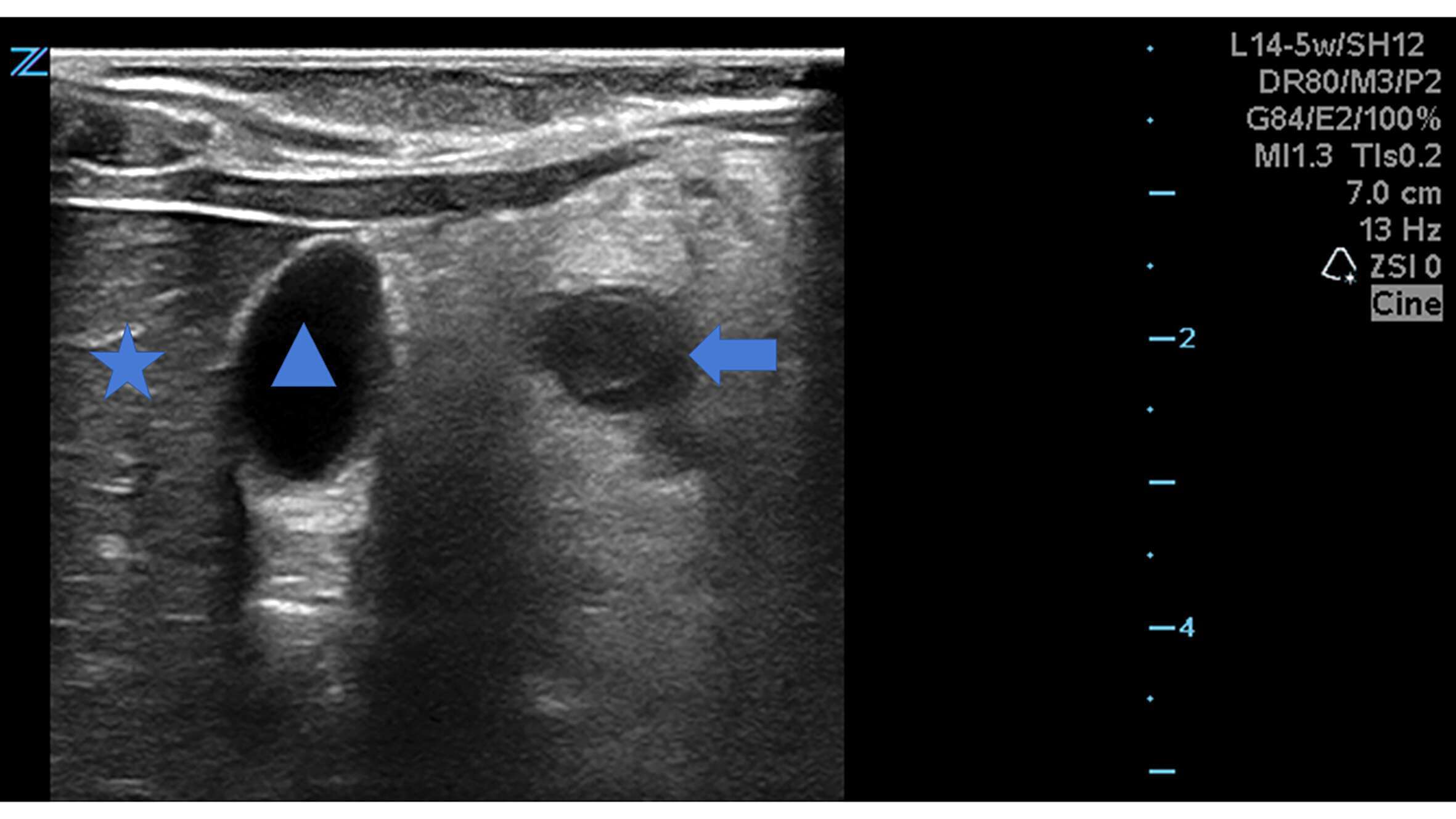 Figure 1, Appendicitis in right upper quadrant